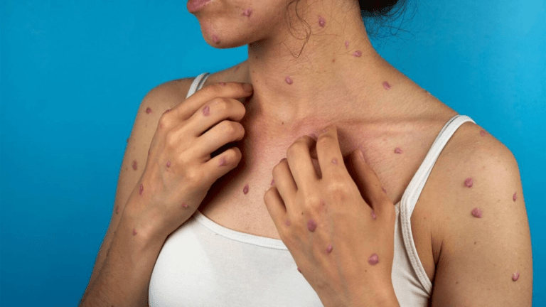 World Health Organization to name monkeypox again as pox